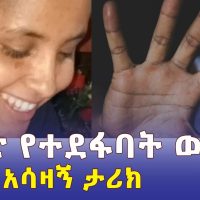 አሲድ የተደፋባት ወጣት አሳዛኝ ታሪክ | Acid attack victim | Ethiopia